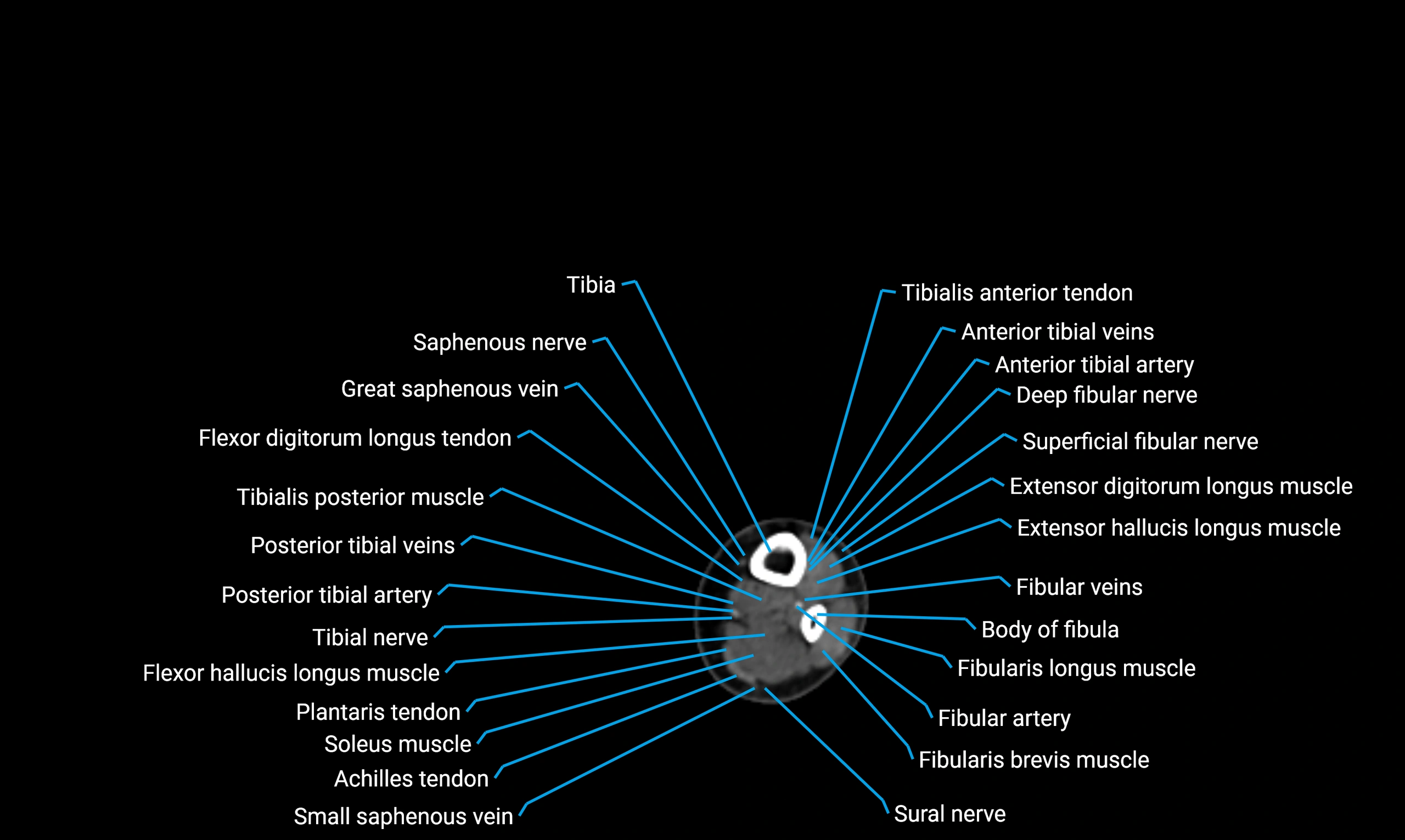 CT lower limb axial cross sectional anatomy labelled image 149 (2).webp
